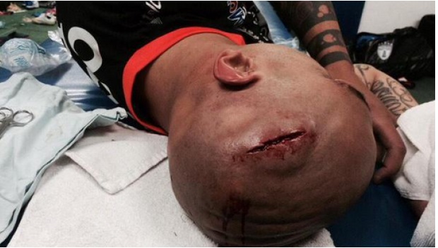 Узнемирујућ снимак: Мексичком фудбалеру напукла глава после судара